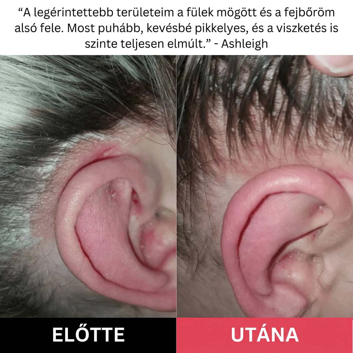 Hairsy - Fejbőr Radír Korpa, Hámlás és Viszketés Ellen