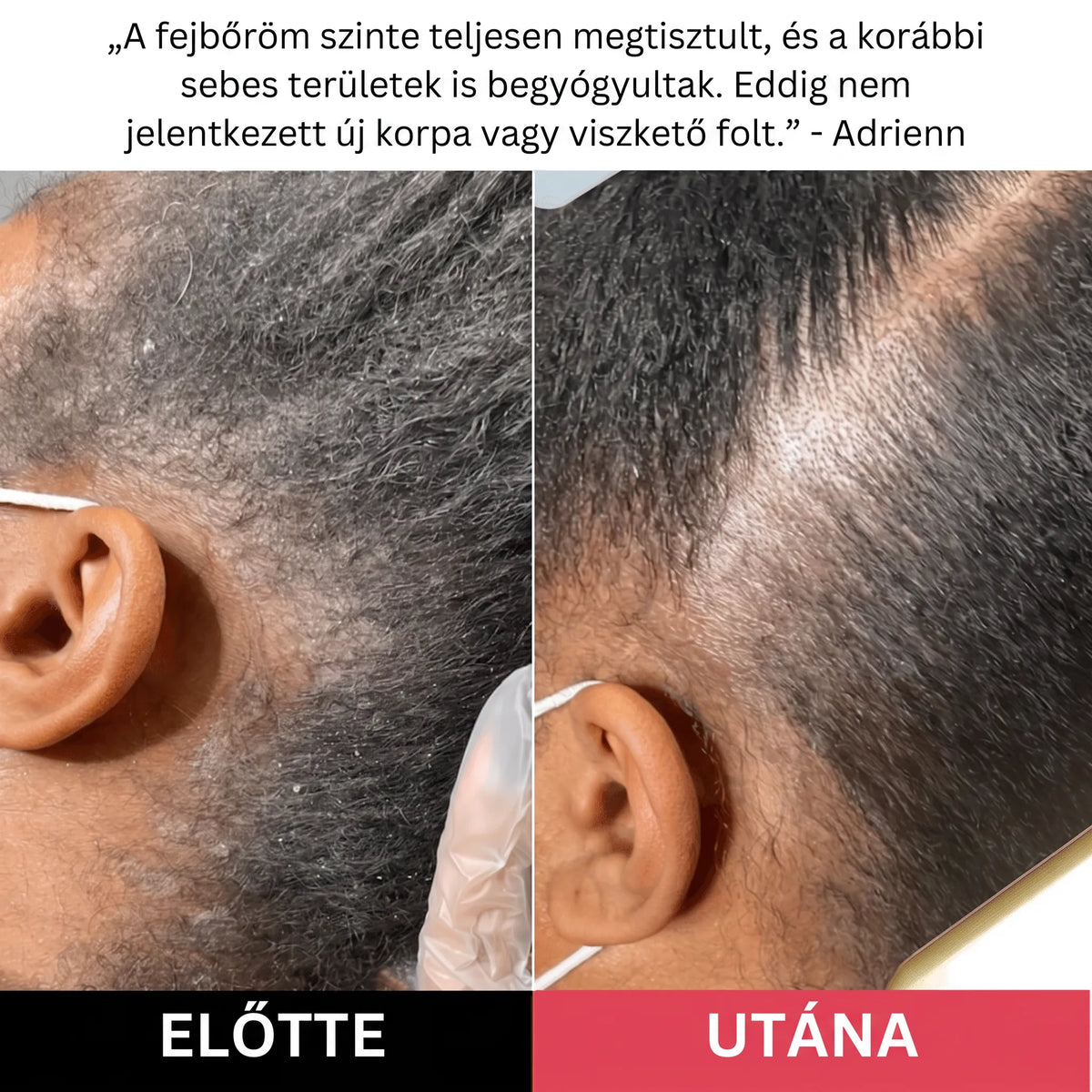 Hairsy - Fejbőr Radír Korpa, Hámlás és Viszketés Ellen