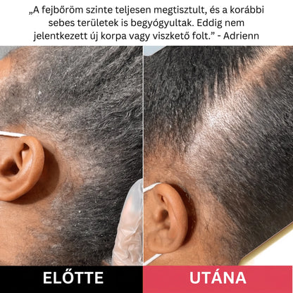 Hairsy - Fejbőr Radír Korpa, Hámlás és Viszketés Ellen